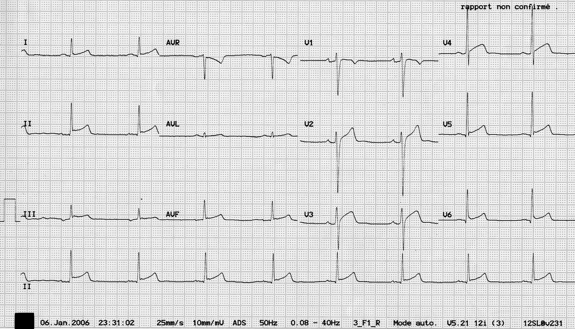 I09-Electrocardiogramme-5289